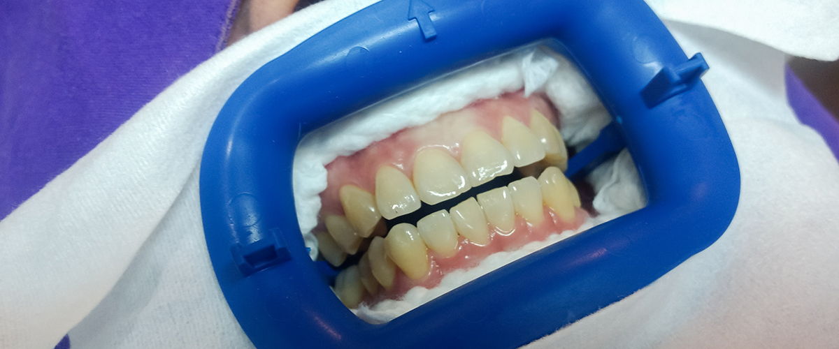 医療機関提携のホワイトニング